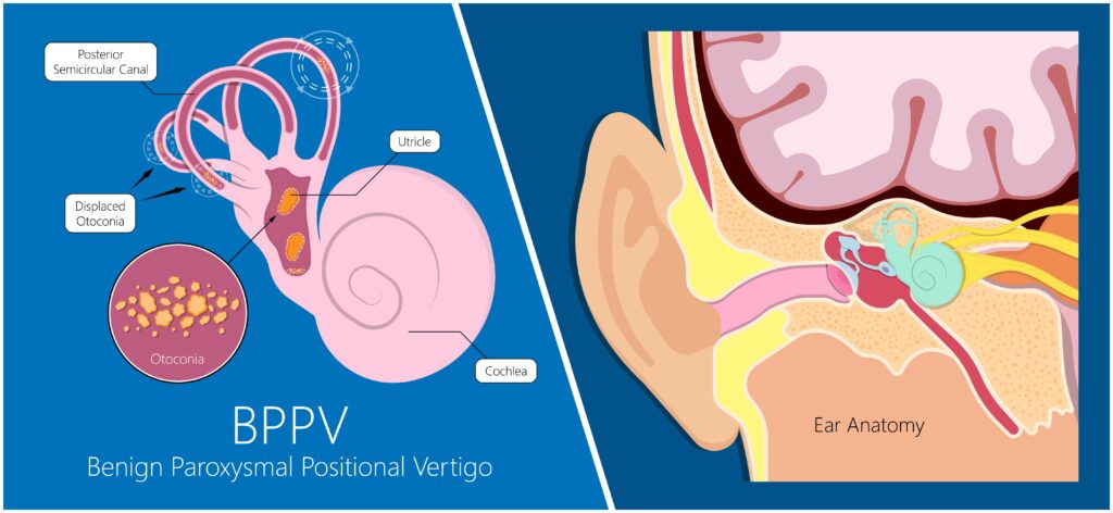 Benign paroxysmal positional vertigo BPPV loss balance dizzy Electronystagmography therapist treat canalith repositioning procedure semicircular canal