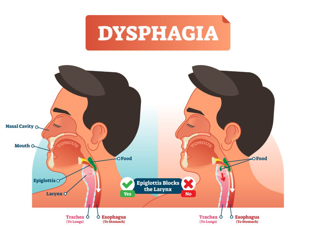 Dysphagia diagram