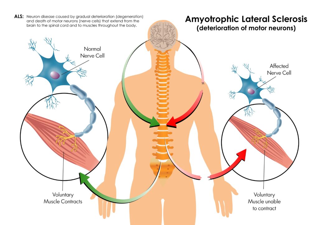 Amyotrophic Lateral Sclerosis