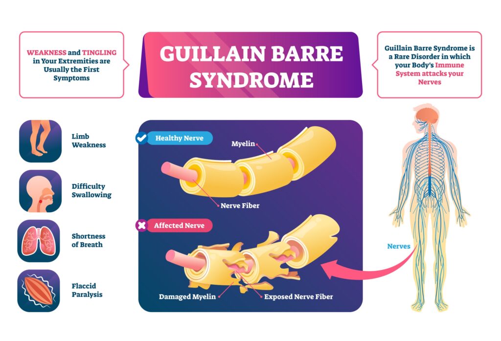 Guillain-Barré Syndrome