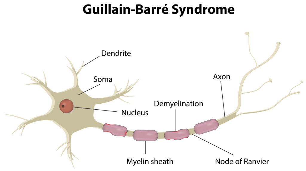 Guillain-Barré Syndrome